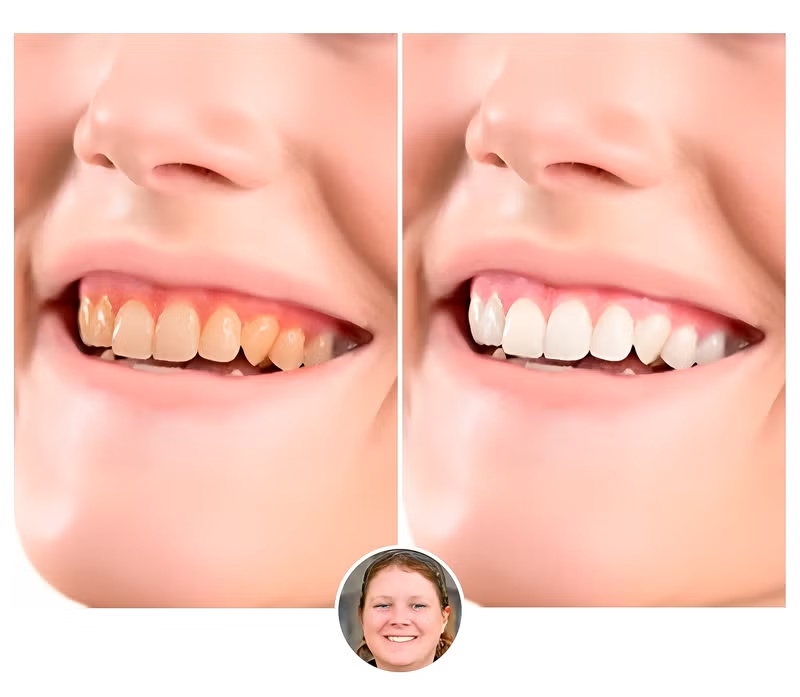 Illustrative before-and-after teeth appearance image shown in product materials